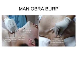 MANIOBRA BURP
 
