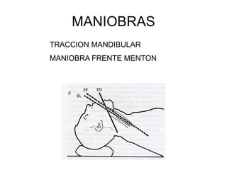 MANIOBRAS
TRACCION MANDIBULAR
MANIOBRA FRENTE MENTON
 
