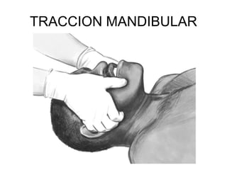 TRACCION MANDIBULAR
 