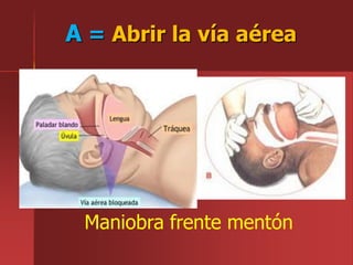 A = Abrir la vía aérea
Maniobra frente mentón
 