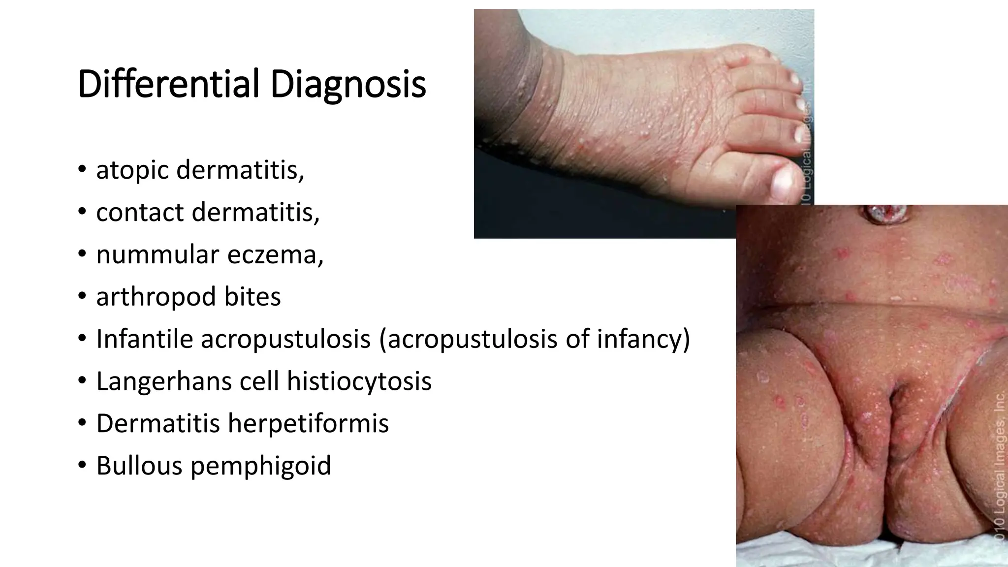 Shaps Infection Scabies etiology, transmission, risk factors, clinical variants ...