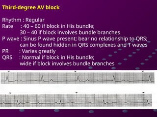 Comprehensive Guide to Cardiac Rhythms and AV Blocks in ECG ...