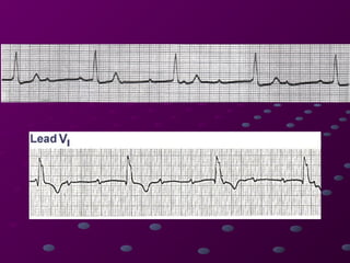 Comprehensive Guide to Cardiac Rhythms and AV Blocks in ECG ...
