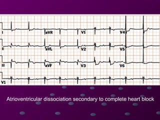 Comprehensive Guide to Cardiac Rhythms and AV Blocks in ECG ...