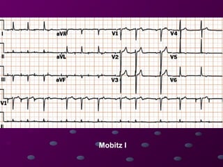 Mobitz Patterns Comprehensive Guide to Cardiac Rhythms and AV Blocks in ECG ...