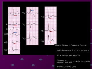 Comprehensive Guide to Cardiac Rhythms and AV Blocks in ECG ...