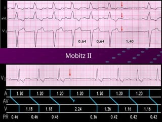Comprehensive Guide to Cardiac Rhythms and AV Blocks in ECG ...