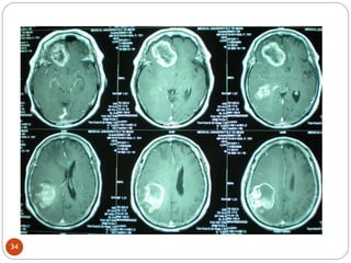 Comprehensive Overview of Brain Tumors: Diagnosis and Treatment | PDF