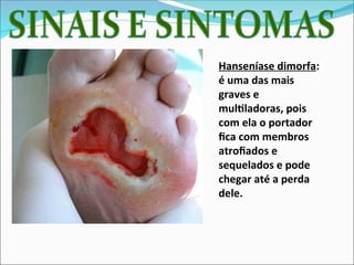 Hanseníase dimorfa:
é uma das mais
graves e
multiladoras, pois
com ela o portador
fica com membros
atrofiados e
sequelados e pode
chegar até a perda
dele.
 
