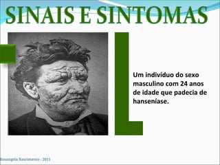 Um indivíduo do sexo
masculino com 24 anos
de idade que padecia de
hanseníase.
Rosangela Nascimento - 2011
 