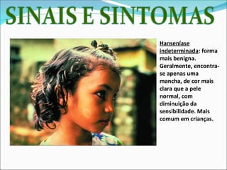 Hanseníase
indeterminada: forma
mais benigna.
Geralmente, encontra-
se apenas uma
mancha, de cor mais
clara que a pele
normal, com
diminuição da
sensibilidade. Mais
comum em crianças.
 