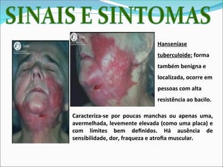 Hanseníase
tuberculoide: forma
também benigna e
localizada, ocorre em
pessoas com alta
resistência ao bacilo.
Caracteriza-se por poucas manchas ou apenas uma,
avermelhada, levemente elevada (como uma placa) e
com limites bem definidos. Há ausência de
sensibilidade, dor, fraqueza e atrofia muscular.
 