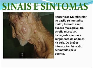 Hanseníase Multibacelar
: o bacilo se multiplica
muito, levando a um
quadro mais grave. Há
atrofia muscular,
inchaço das pernas e
surgimento de nódulos
na pele. Os órgãos
internos também são
acometidos pela
doença.
 