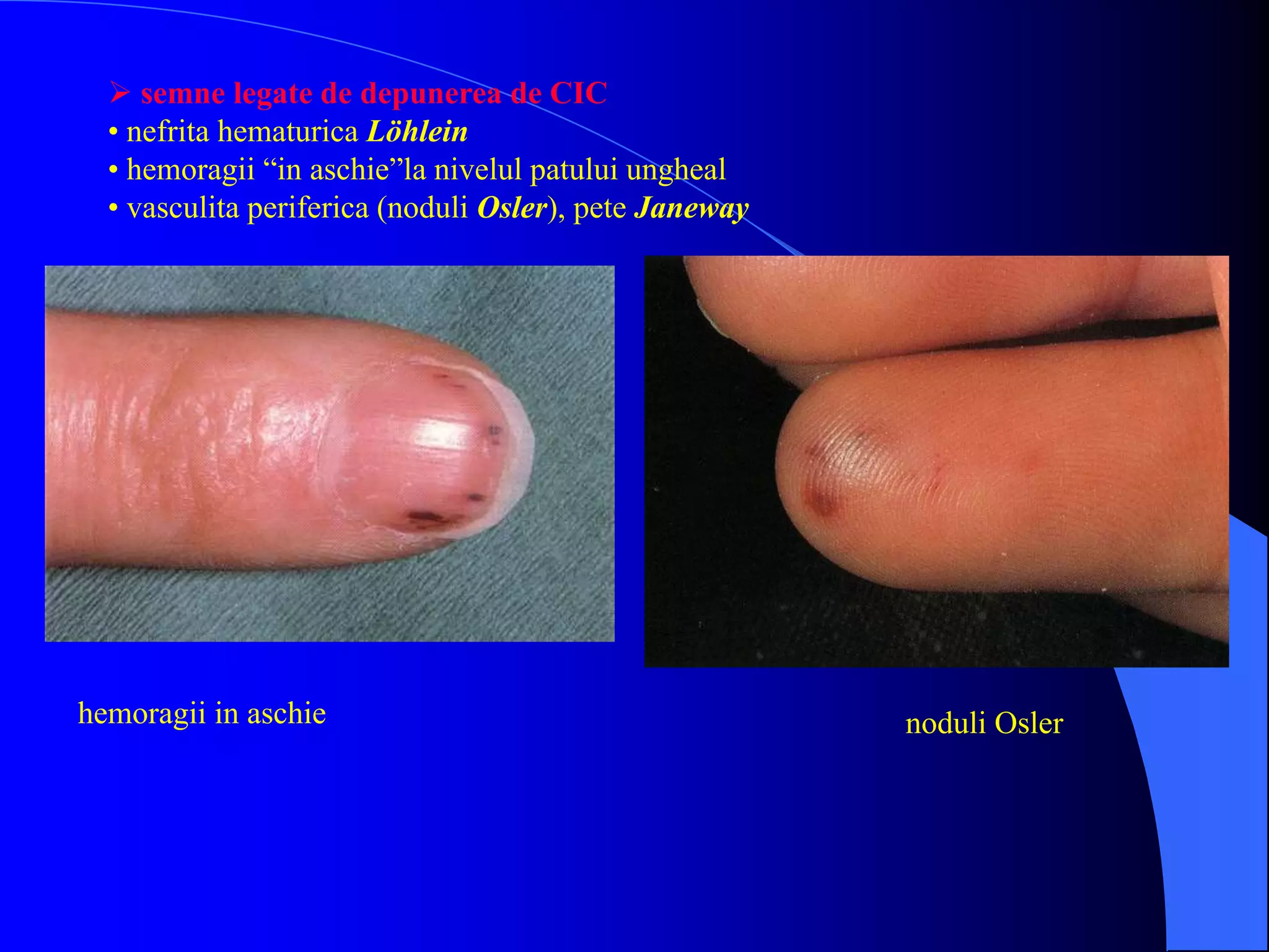  semne legate de depunerea de CIC
• nefrita hematurica Löhlein
• hemoragii “in aschie”la nivelul patului ungheal
• vasculita periferica (noduli Osler), pete Janeway
hemoragii in aschie noduli Osler
 