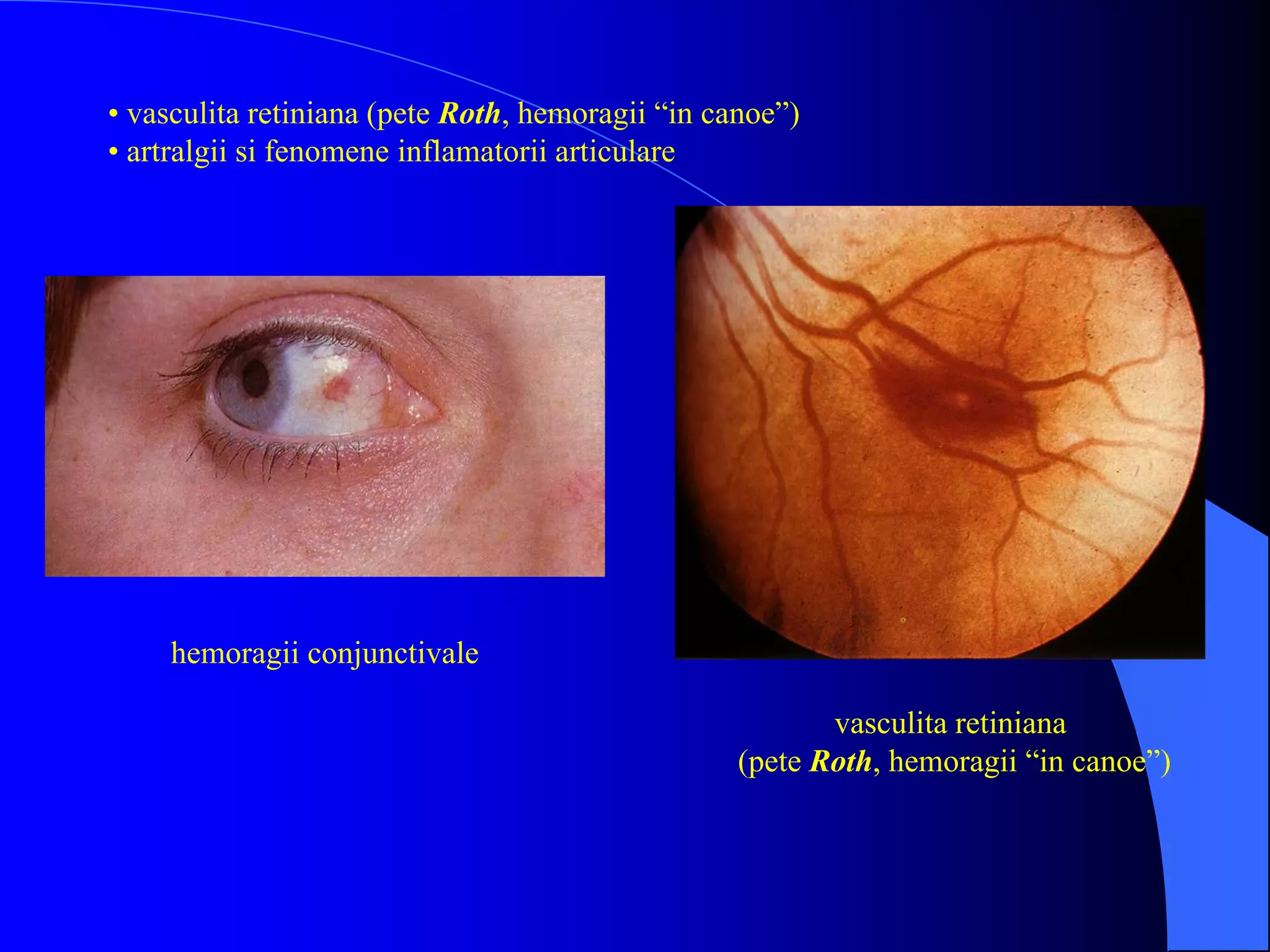 hemoragii conjunctivale
vasculita retiniana
(pete Roth, hemoragii “in canoe”)
• vasculita retiniana (pete Roth, hemoragii “in canoe”)
• artralgii si fenomene inflamatorii articulare
 