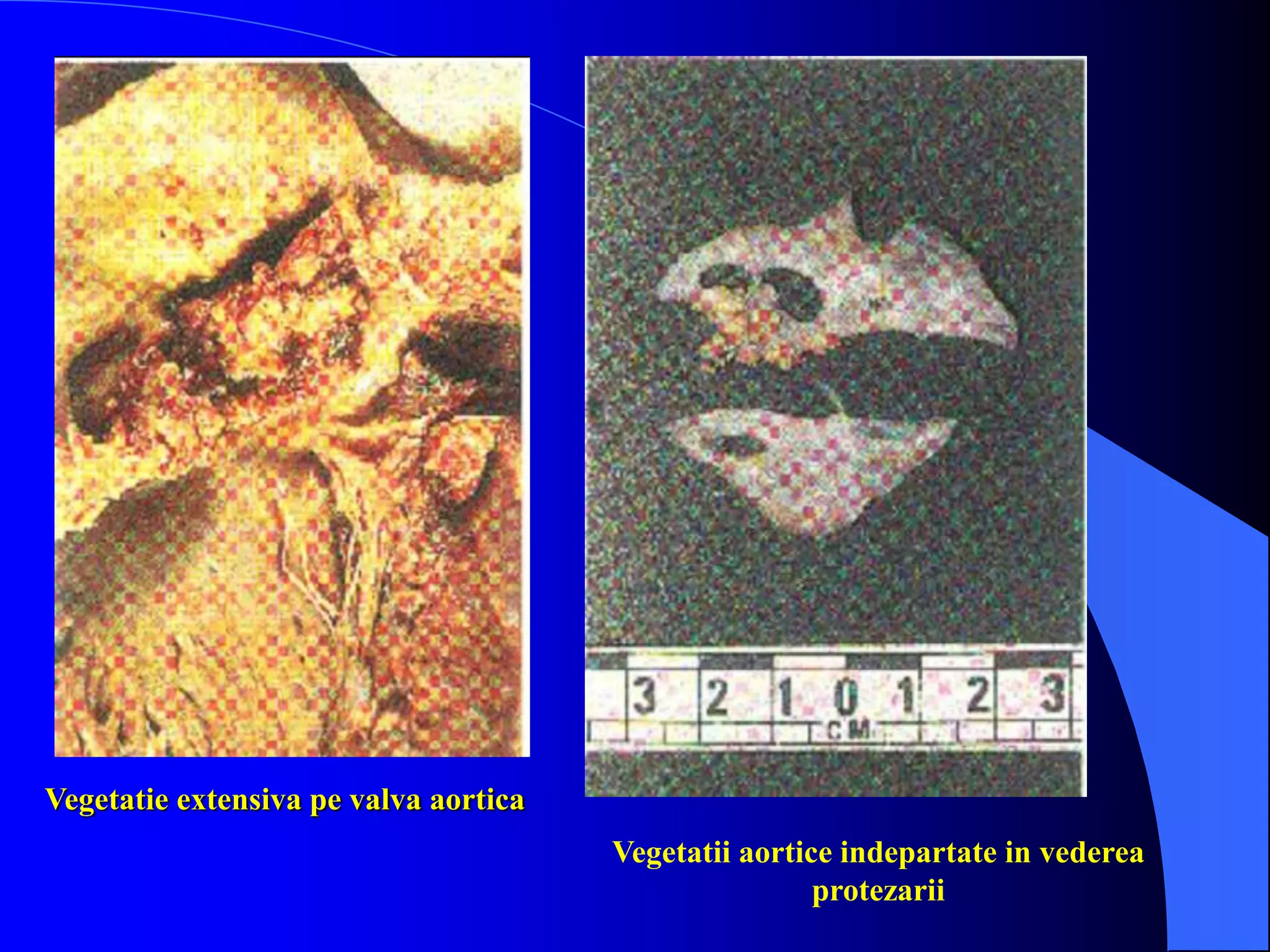 Vegetatie extensiva pe valva aortica
Vegetatii aortice indepartate in vederea
protezarii
 