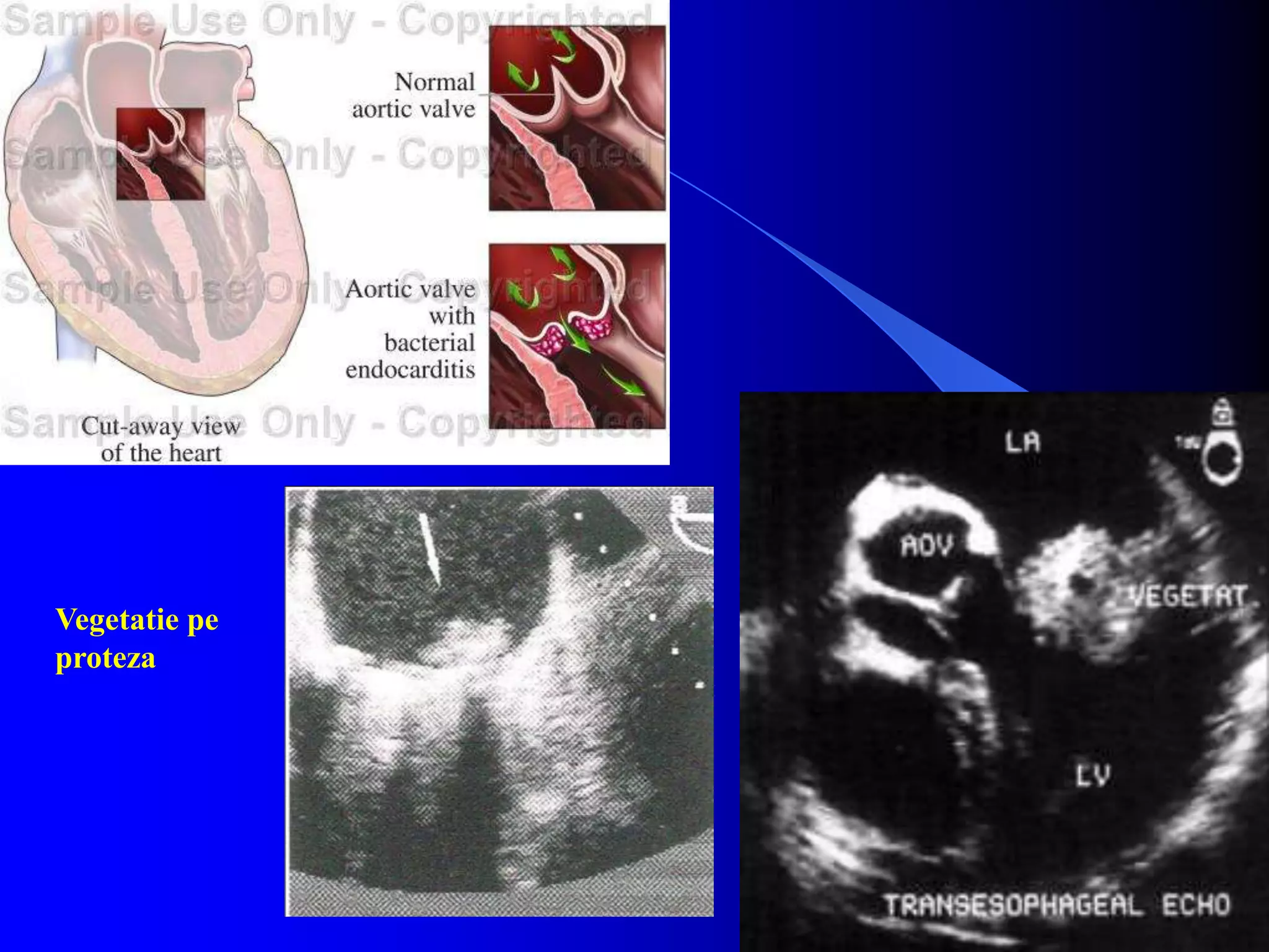 Vegetatie pe
proteza
 