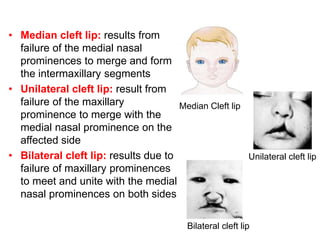 • Median cleft lip: results from
failure of the medial nasal
prominences to merge and form
the intermaxillary segments
• Unilateral cleft lip: result from
failure of the maxillary
prominence to merge with the
medial nasal prominence on the
affected side
• Bilateral cleft lip: results due to
failure of maxillary prominences
to meet and unite with the medial
nasal prominences on both sides
Median Cleft lip
Unilateral cleft lip
Bilateral cleft lip
 