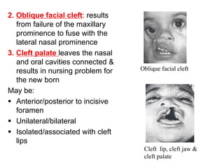 2. Oblique facial cleft: results
from failure of the maxillary
prominence to fuse with the
lateral nasal prominence
3. Cleft palate leaves the nasal
and oral cavities connected &
results in nursing problem for
the new born
May be:
 Anterior/posterior to incisive
foramen
 Unilateral/bilateral
 Isolated/associated with cleft
lips
Cleft lip, cleft jaw &
cleft palate
Oblique facial cleft
 