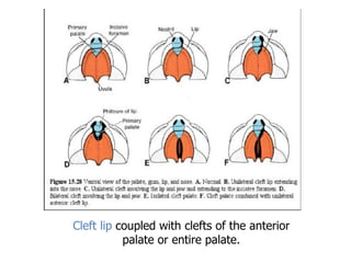 Cleft lip coupled with clefts of the anterior
palate or entire palate.
 