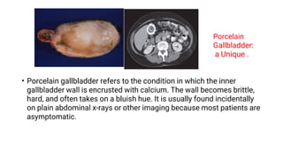 03-Diseases of gall bladder.pdf