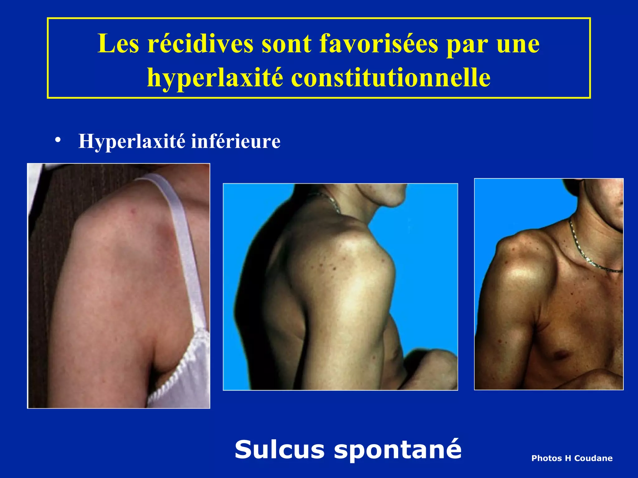 Les récidives sont favorisées par une
        hyperlaxité constitutionnelle

• Hyperlaxité inférieure




                   Sulcus spontané      Photos H Coudane
 