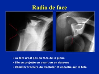 Radio de face




• La tête n’est pas en face de la glène
• Elle se projette en avant ou en dessous
• Dépister fracture du...