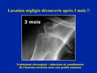 4/ Fracture du trochin




           Arrachement rare du trochin
                (sous-scapulaire)



  Traitement chirur...