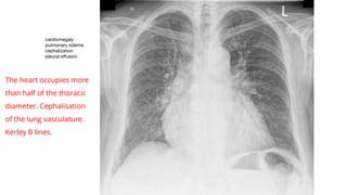 03 - Heart Failureqouw fdqowufdq0oufqfqwufeg | PDF