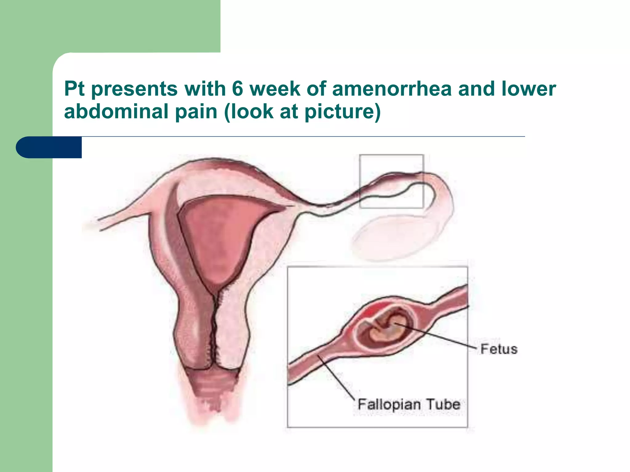 Pt presents with 6 week of amenorrhea and lower
abdominal pain (look at picture)
 