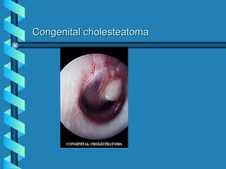 Congenital cholesteatoma
 
