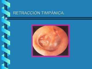 RETRACCIÓN TIMPÁNICA.
 