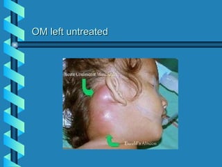OM left untreated
 