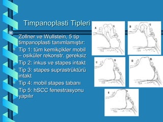 Timpanoplasti Tipleri
    Zollner ve Wullstein, 5 tip
    timpanoplasti tanımlamıştır:
a   Tip 1: tüm kemikçikler mobil
    – osiküler rekonstr. gereksiz
a   Tip 2: inkus ve stapes intakt
a   Tip 3: stapes suprastrüktürü
    intakt
a   Tip 4: mobil stapes tabanı
a   Tip 5: hSCC fenestrasyonu
    yapılır
 