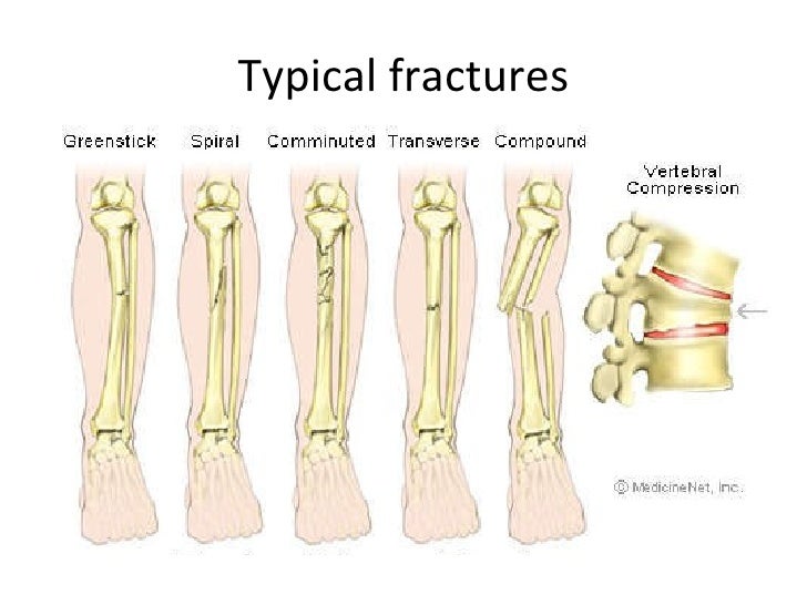 ortho 03 principle of closed reduction in fracture and dislocation