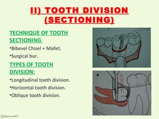 Tooth Bisection Surgical removal of teeth and roots | PPT