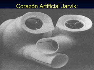 Corazón Artificial Jarvik: 