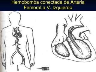 Hemobomba conectada de Arteria Femoral a V. Izquierdo 