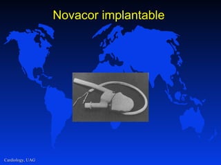 Novacor implantable 
