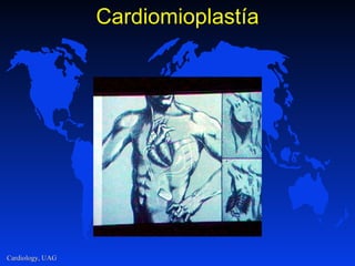 Cardiomioplastía 