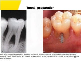 Tunnel preparation
23
 
