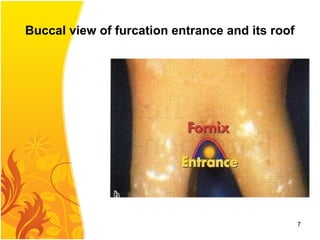 Buccal view of furcation entrance and its roof
7
 