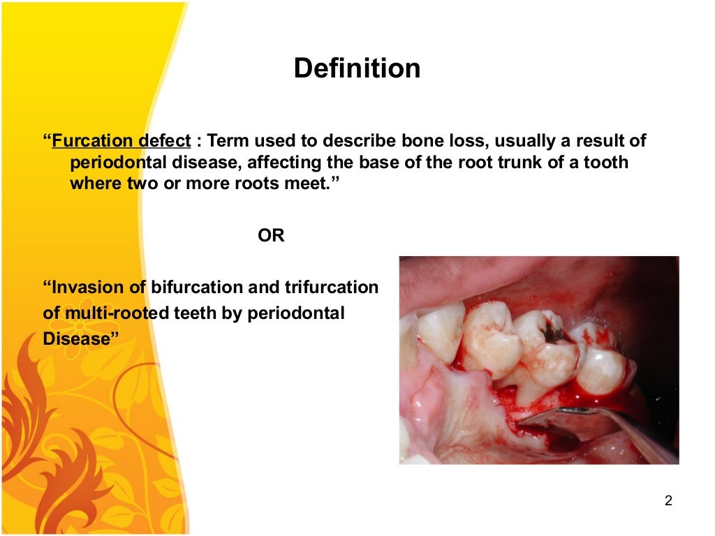 030.furcation involvement and its therapy