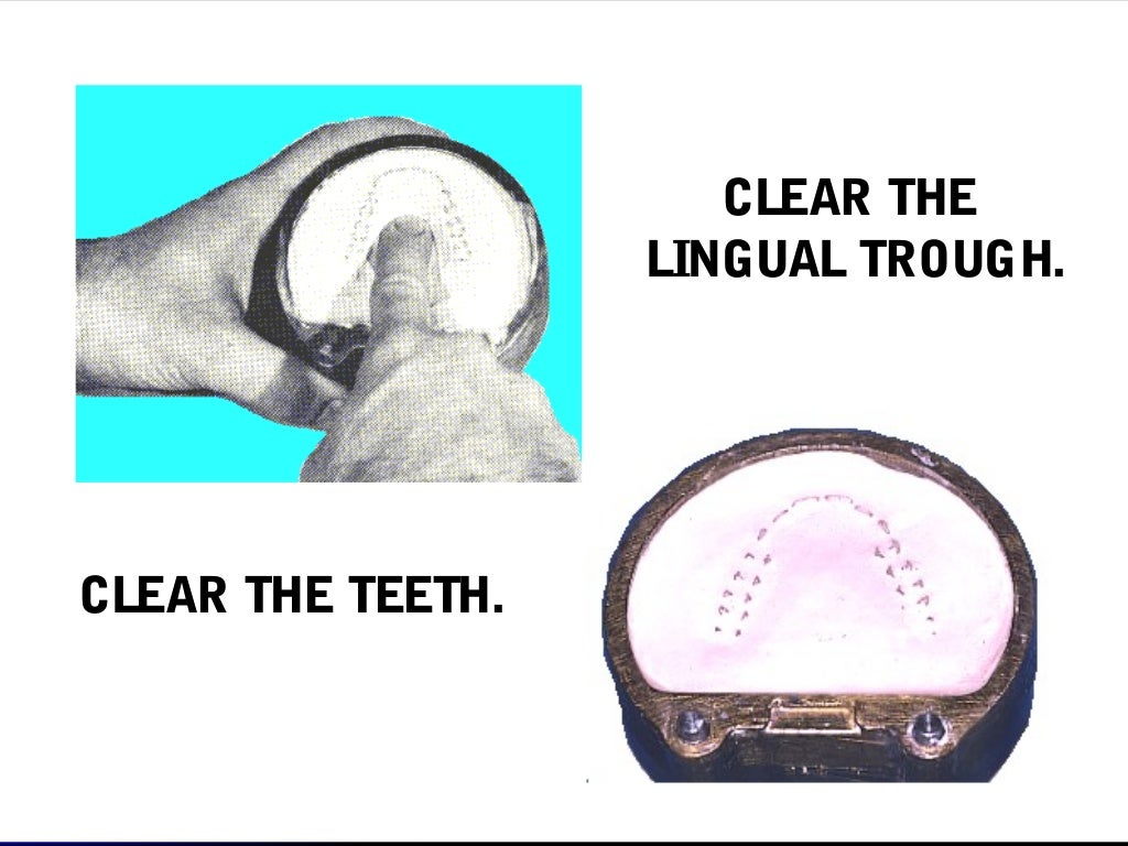 03 01 01_45(flasking and processing complete denture)