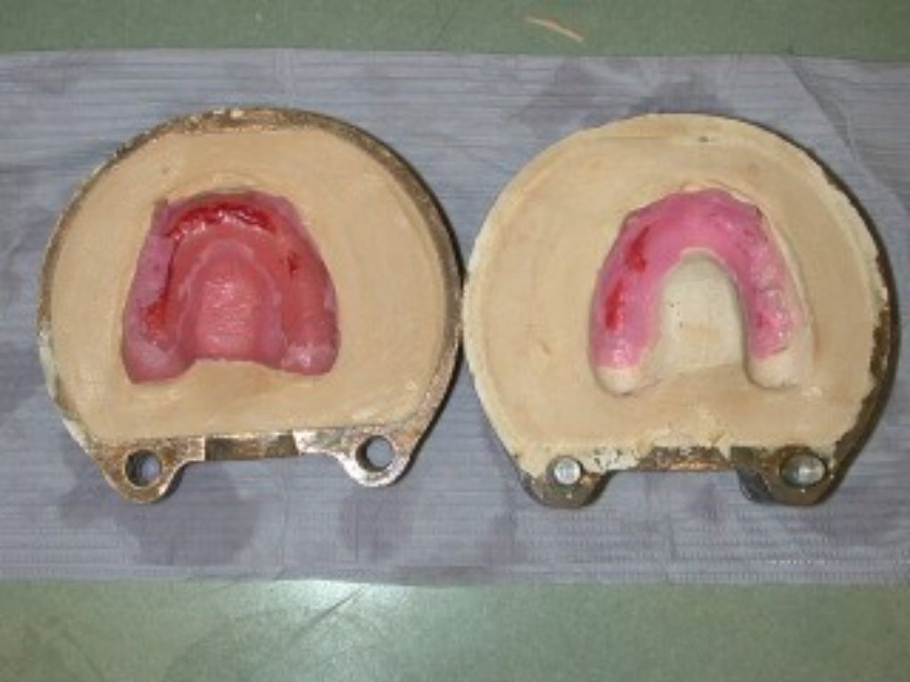 03 01 01_45(flasking and processing complete denture)