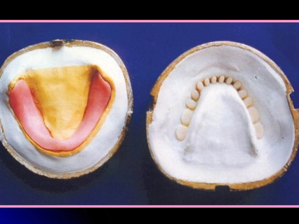 03 01 01_45(flasking and processing complete denture)