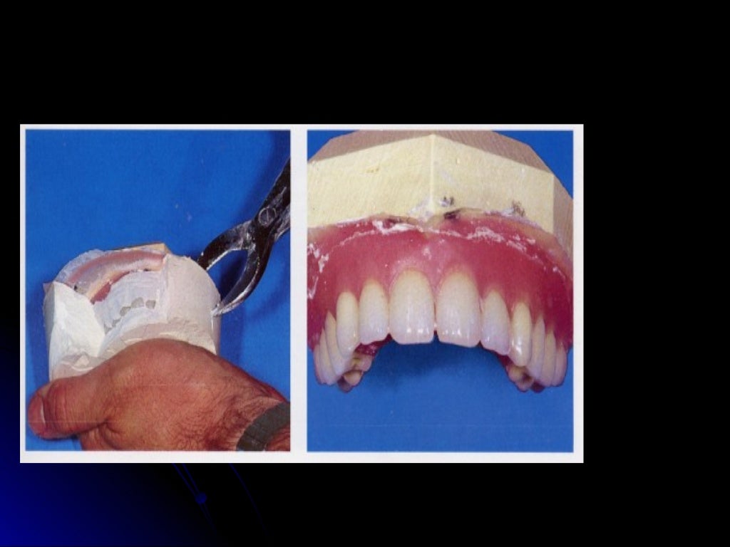 03 01 01_45(flasking and processing complete denture)