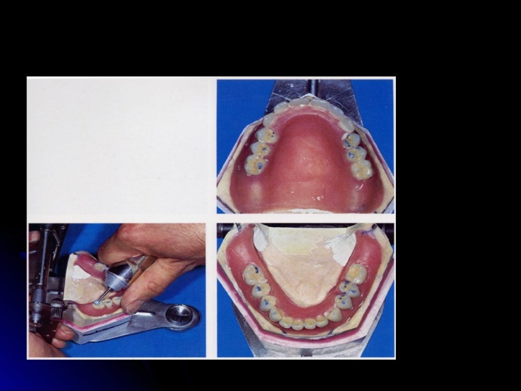 03 01 01_45(flasking and processing complete denture)
