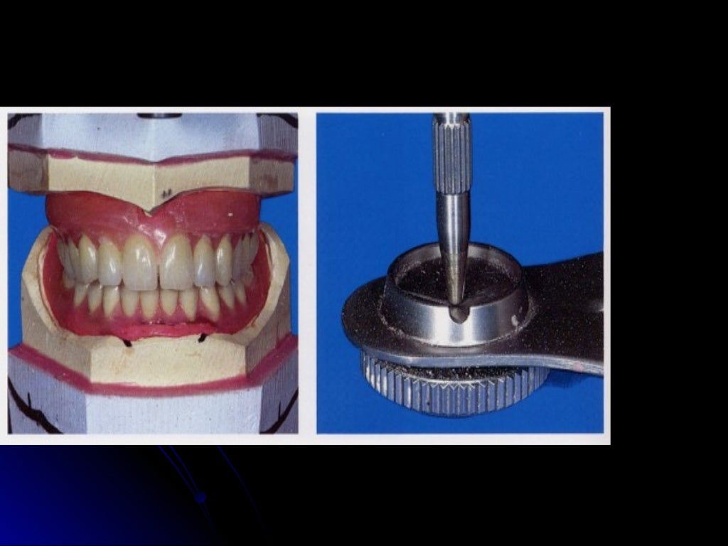03 01 01_45(flasking and processing complete denture)