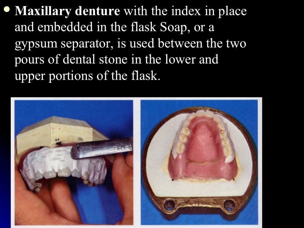 03 01 01_45(flasking and processing complete denture)